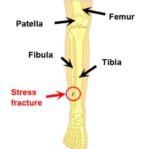 foot stress reaction